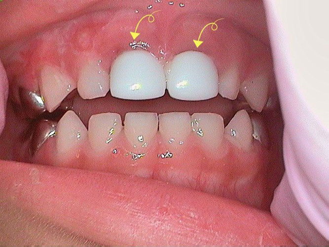 Nusmile crowns