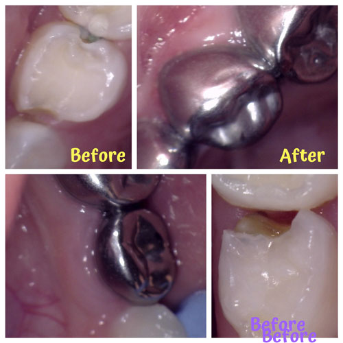 Stainless Steel crowns
