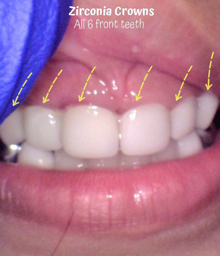 Zirc crowns