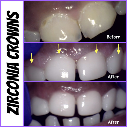 Zirc crowns