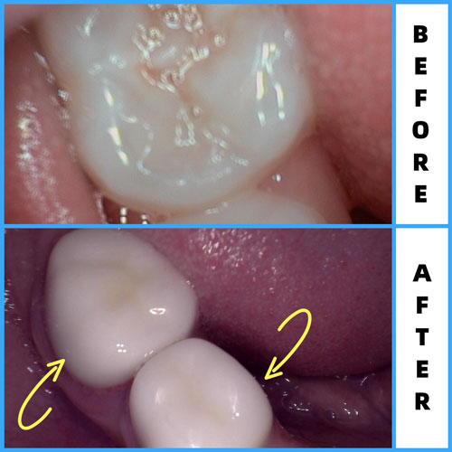 Zirc crowns