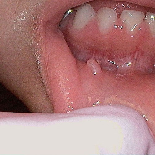 Mucocele
